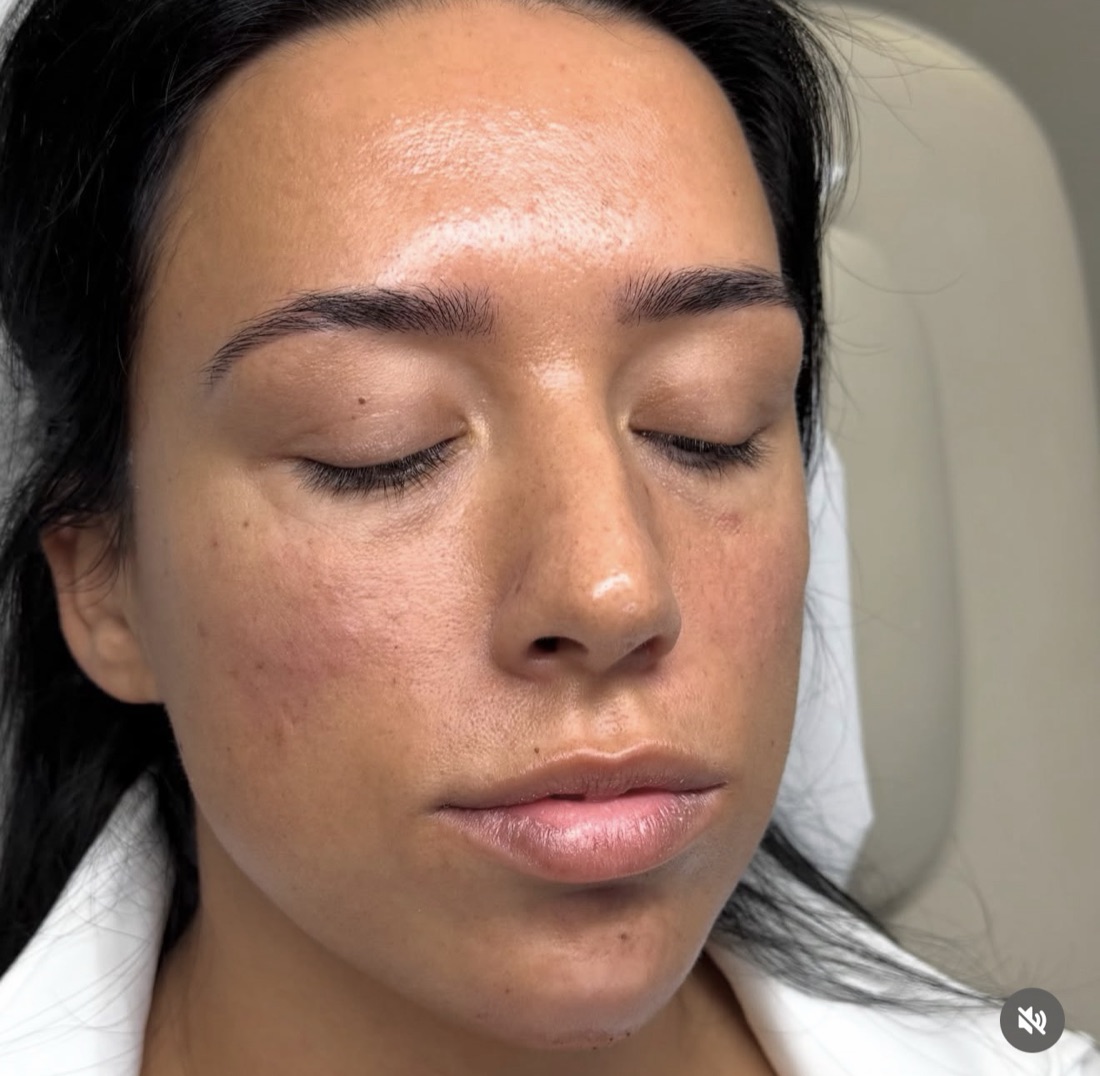 Skin after — smoother with a healthy glow